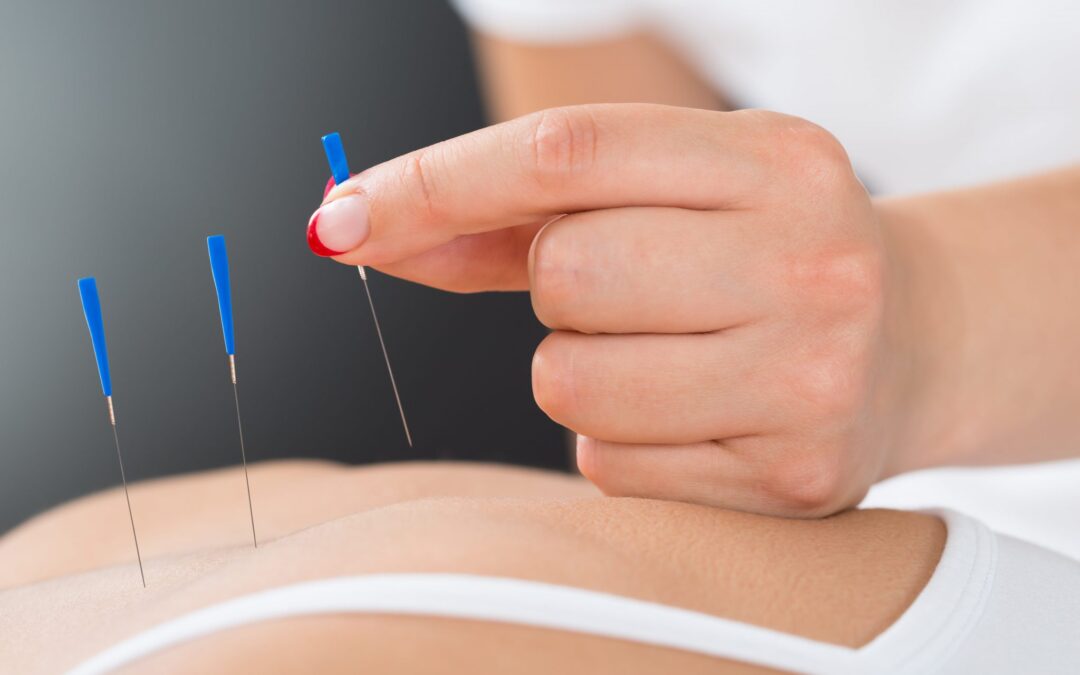 Acupuncture-min